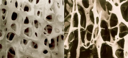 osteioporosis