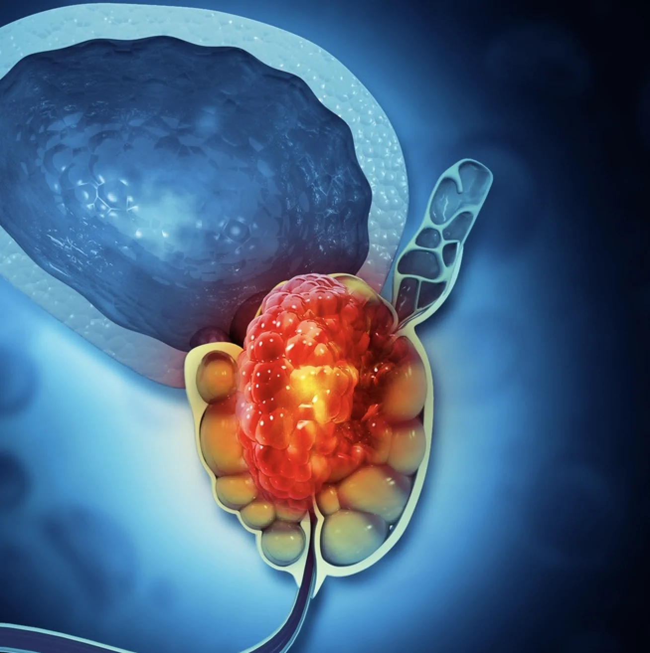 Home Keep Healthy How to avoid prostate cancer